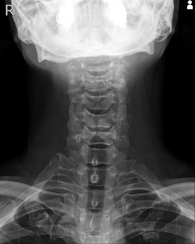 首の骨の正面からのレントゲン