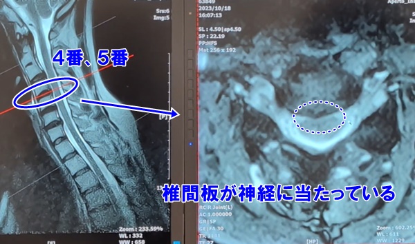 MRI検査結果説明｜頸椎椎間板ヘルニアかどうか結果を診断