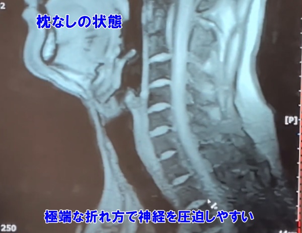 MRI検査結果説明｜頸椎椎間板ヘルニアかどうか結果を診断
